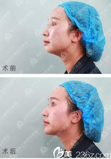 玻尿酸豐下巴術(shù)后即刻效果對比