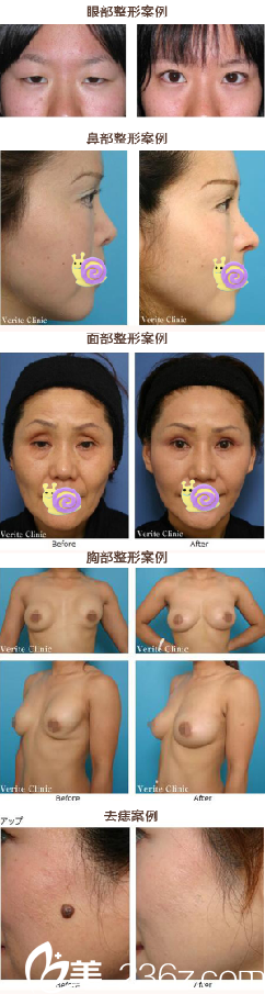 整形案例前后對比