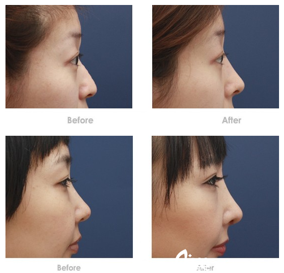 仝潤澤隆鼻案例 仝潤澤隆鼻案例