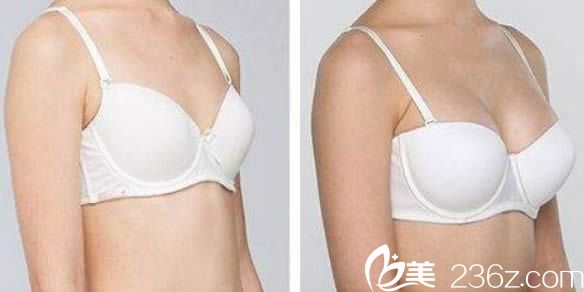 王家林醫(yī)生自體脂肪豐胸案例 王家林醫(yī)生自體脂肪豐胸案例