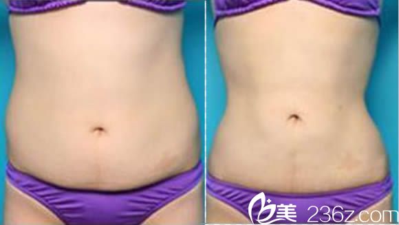 王家林腰腹部吸脂前后對(duì)比效果圖 王家林腰腹部吸脂前后對(duì)比效果圖