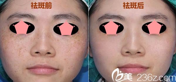 寧德華美激光祛斑前后對(duì)比效果