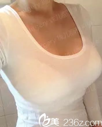 韓國珠兒麗假體隆胸手術(shù)5個月效果 韓國珠兒麗假體隆胸手術(shù)5個月效果