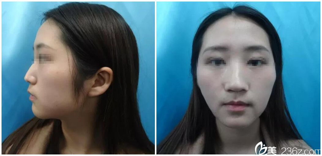 術(shù)前面頰過于消瘦顯老 術(shù)前面頰過于消瘦顯老