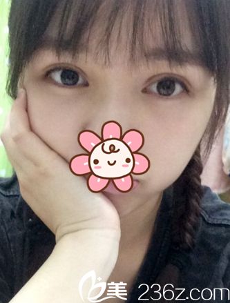 原來(lái)整形冶春梅給做的7mm全切雙眼皮是這樣啊