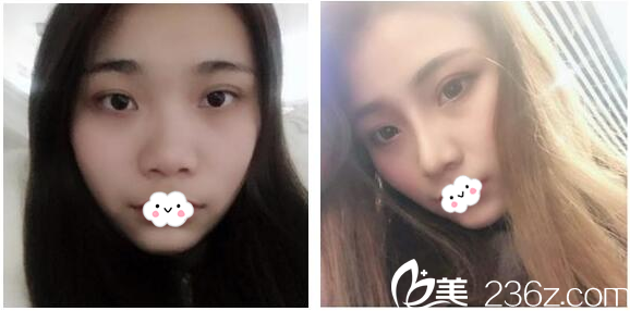 廣州美萊醫(yī)療美容醫(yī)院劉豪隆鼻案例 廣州美萊醫(yī)療美容醫(yī)院劉豪隆鼻案例