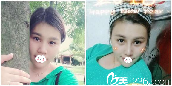 廣州美萊劉豪鼻綜合隆鼻案例對比圖 廣州美萊劉豪鼻綜合隆鼻案例對比圖