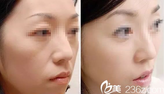 寧波壹加壹芙媄登玻尿酸填充面頰<span style=