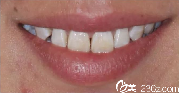 尤樂平牙修復(fù)術(shù)前