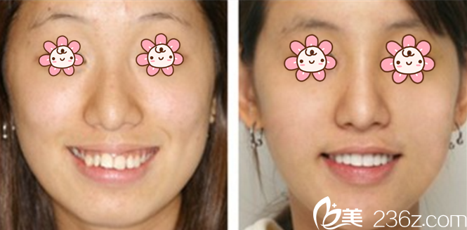 趙郡凡牙齒正畸案例 趙郡凡牙齒正畸案例