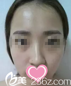 術前照片 術前照片