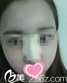 鼻整形術后第五天 鼻整形術后第五天