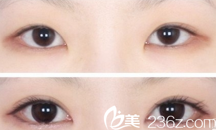 廣州壹加壹項美蓮埋線雙眼皮失敗修復(fù)案例 廣州壹加壹項美蓮埋線雙眼皮失敗修復(fù)案例