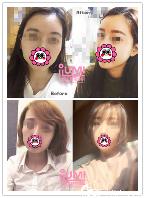 輪廓整形真人<span style=