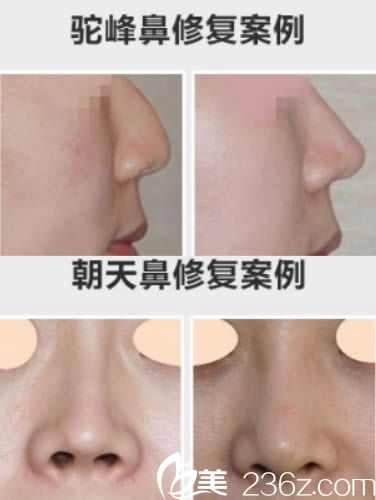 廈門薇格劉洋鼻綜合修復(fù)案例 廈門薇格劉洋鼻綜合修復(fù)案例
