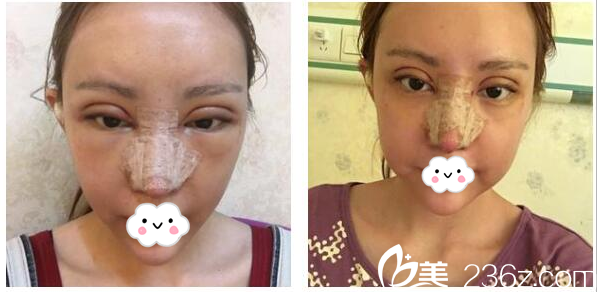 廣州韓妃李光琴雙眼皮隆鼻第2天 廣州韓妃李光琴雙眼皮隆鼻第2天