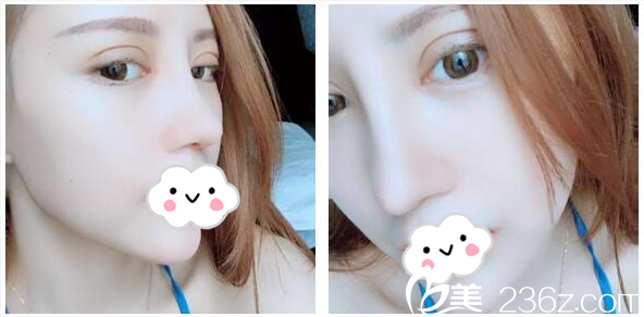 李光琴醫(yī)生做的雙眼皮隆鼻13天恢復(fù)情況 李光琴醫(yī)生做的雙眼皮隆鼻13天恢復(fù)情況