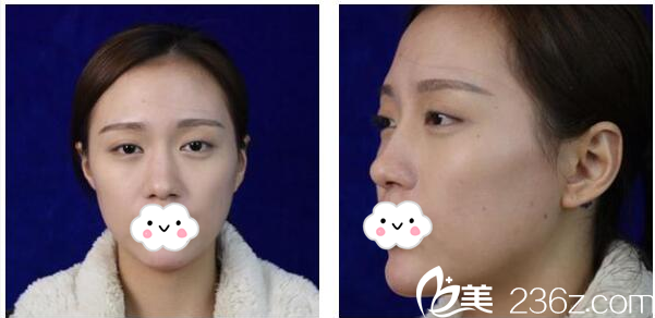 整形術(shù)前照片 整形術(shù)前照片