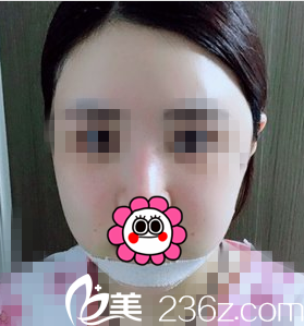 術(shù)后第五天效果 術(shù)后第五天效果