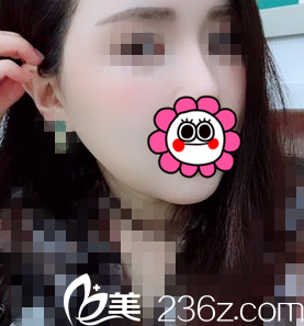 術(shù)后20天基本消腫了 術(shù)后20天基本消腫了