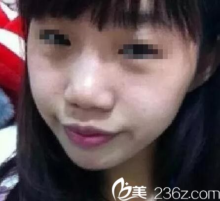 隆鼻術前 隆鼻術前