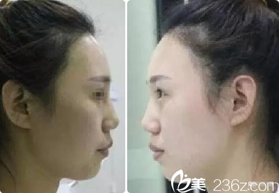 側面看鼻子塌嘴巴凸 側面看鼻子塌嘴巴凸