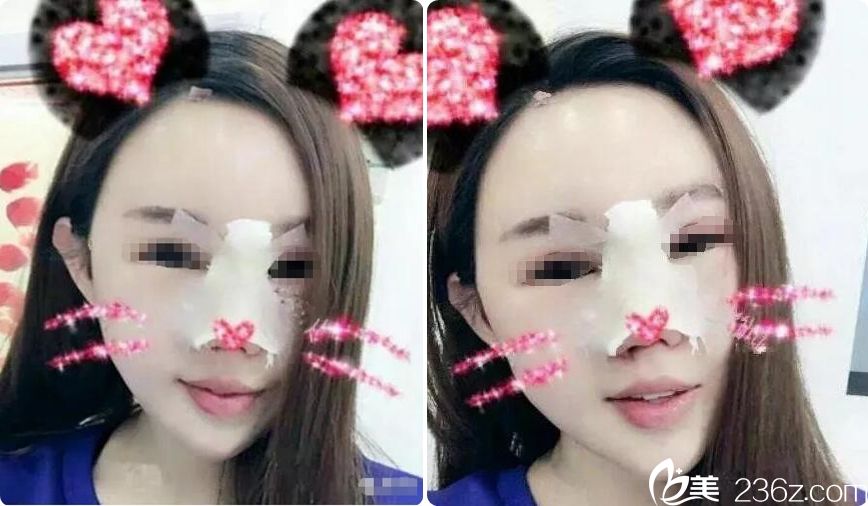 隆鼻+脂肪填充術后即刻 隆鼻+脂肪填充術后即刻