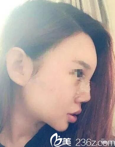 術后第七天鼻部拆線恢復 術后第七天鼻部拆線恢復