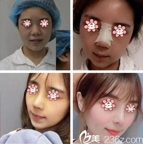 李誠(chéng)桓隆鼻案例