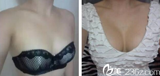 宋在鏞院長乳房下垂矯正案例 宋在鏞院長乳房下垂矯正案例