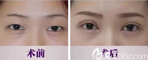 廈門薇格林高萍雙眼皮案例 廈門薇格林高萍雙眼皮案例