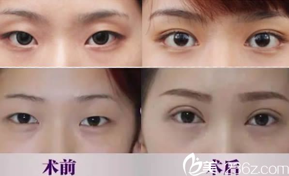 劉輔蓉切開雙眼皮15天恢復效果圖 劉輔蓉切開雙眼皮15天恢復效果圖