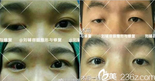 劉輔蓉雙眼皮失敗修復案例 劉輔蓉雙眼皮失敗修復案例