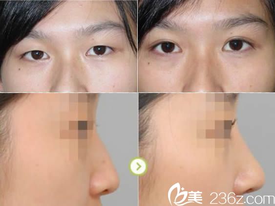 廈門華美林劍超雙眼皮和假體隆鼻案例
