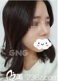 鷹鉤鼻的我在韓國GNG整形醫(yī)院做鼻子，從此改變了我的人生