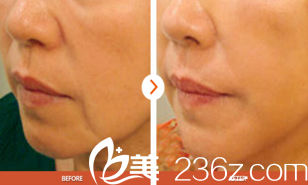 青春祛皺對(duì)比照片