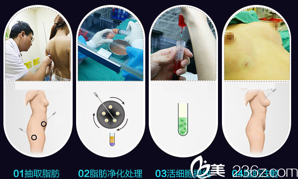 自體脂肪豐胸過程