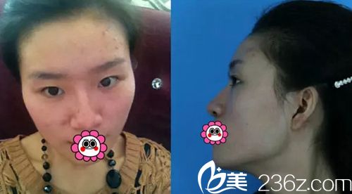 我在長春麥西美嘉做改臉型+眼鼻整形術前 我在長春麥西美嘉做改臉型+眼鼻整形術前