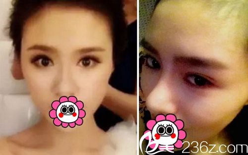 我在長春麥西美嘉做改臉型+眼鼻整形術后3個月 我在長春麥西美嘉做改臉型+眼鼻整形術后3個月