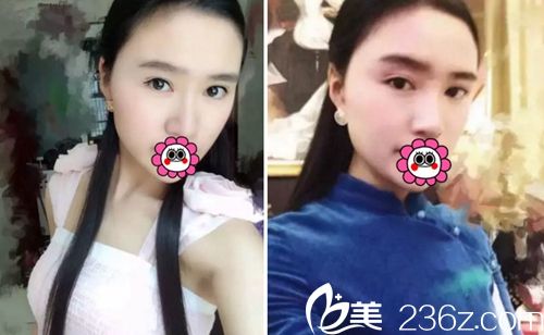 我在長春麥西美嘉做改臉型+眼鼻整形術后半年 我在長春麥西美嘉做改臉型+眼鼻整形術后半年