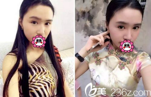 記錄我在長(zhǎng)春麥西美嘉整形醫(yī)院做改臉型+眼鼻整形術(shù)后1年恢復(fù)過(guò)程