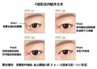 長春麥西美嘉Z成形法開內眼角效果