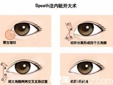 長春麥西美嘉Speath法開內眼角手術