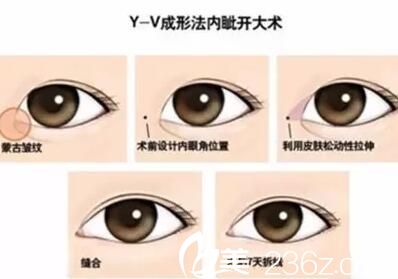 長春麥西美嘉Y-V成形法開內眼角手術