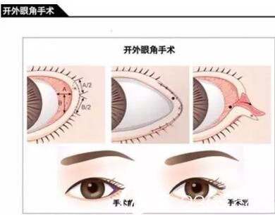 長春麥西美嘉開外內眼角手術