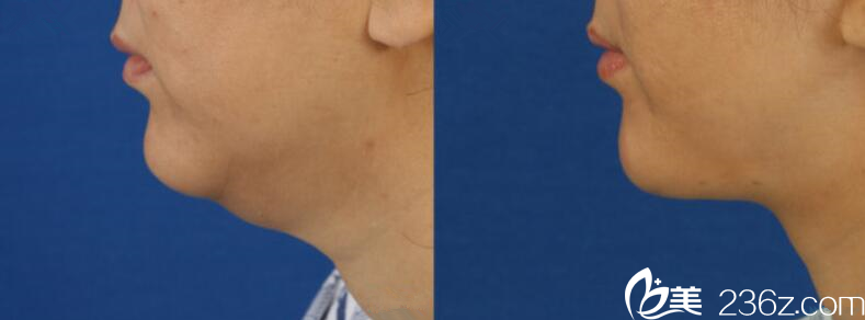 柳永天院長童顏術(shù)（祛除雙下巴）