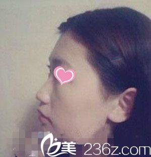 韓國LUX整形醫(yī)院隆鼻