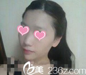 韓國LUX整形醫(yī)院自體脂肪豐額頭