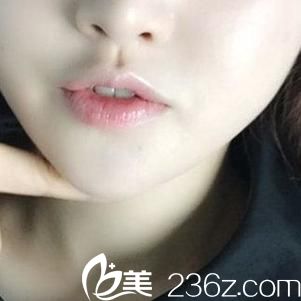 韓國LUX整形醫(yī)院做激光溶脂瘦下巴手術(shù)很厲害，看看我做后的效果