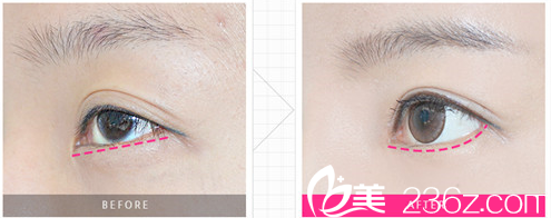 韓國K整形醫(yī)院糖果眼 韓國K整形醫(yī)院糖果眼